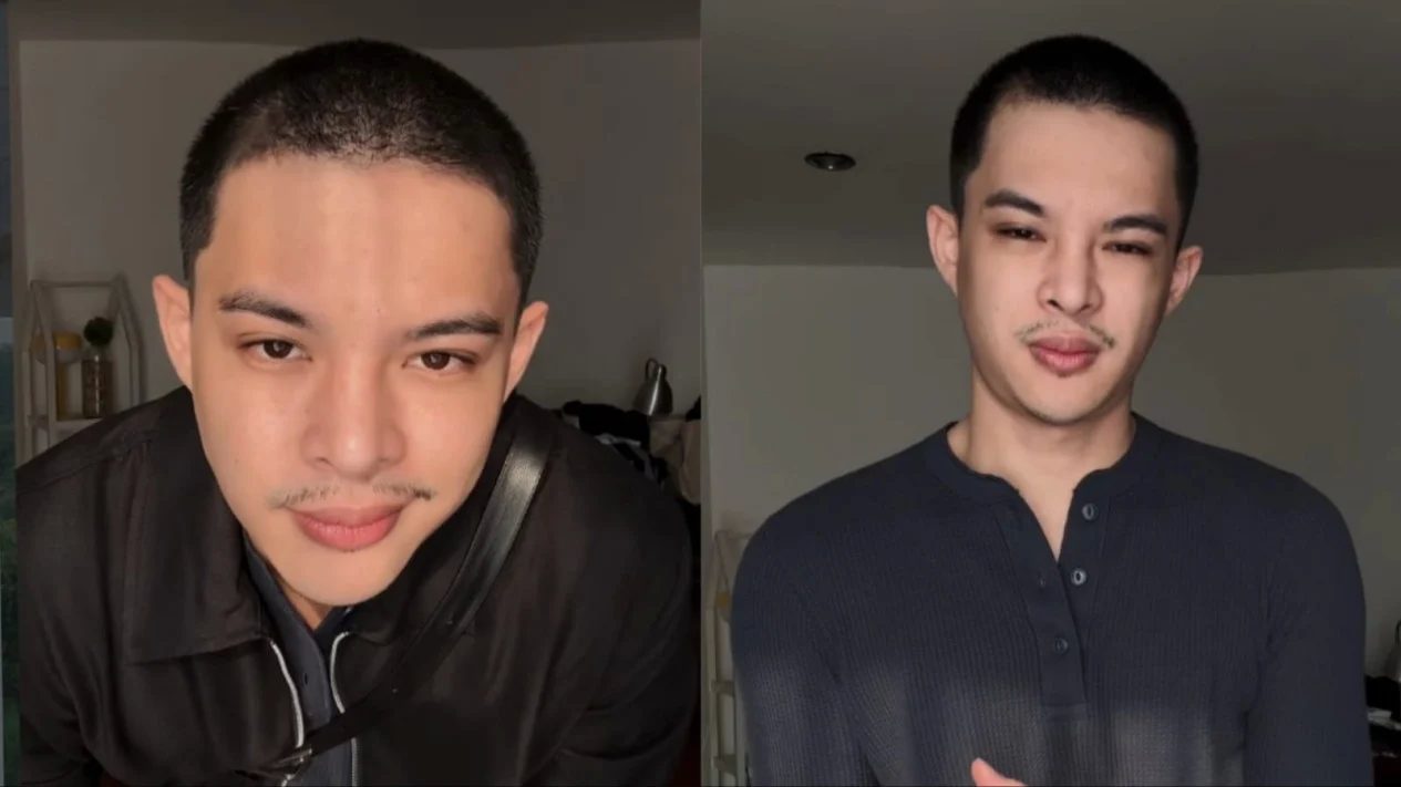 Rey Mbayang Mengidap Psoriasis Autoimun, Penampilannya Berubah Drastis!