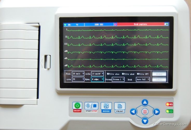 Penyebab Detak Jantung Terlalu Cepat Saat Pemeriksaan EKG Medical Check Up