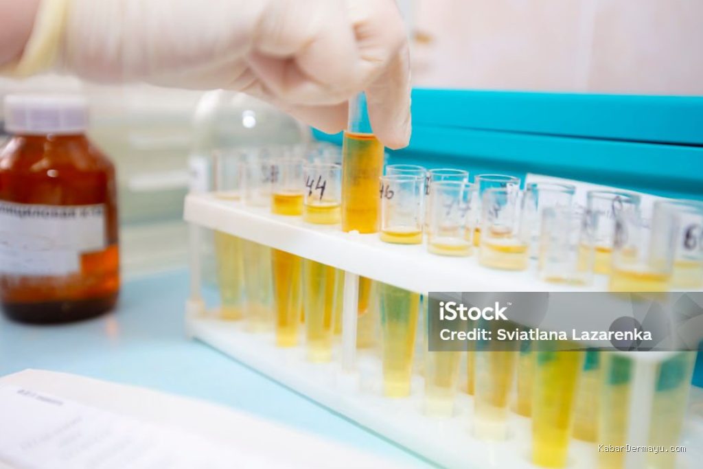 Penyebab Hasil Tes Urin MCU Kerja Menunjukkan Tanda Protein Tinggi