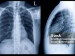 Photo by istockphoto.com - Penyebab Utama Gagal Medical Check Up MCU Pabrik Bagian Rontgen Paru-paru