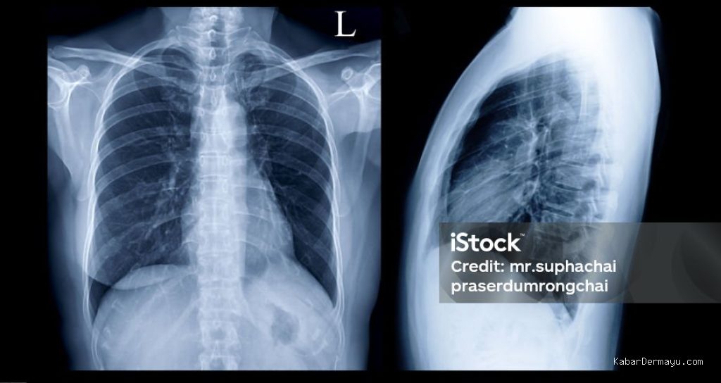 Photo by istockphoto.com - Penyebab Utama Gagal Medical Check Up MCU Pabrik Bagian Rontgen Paru-paru