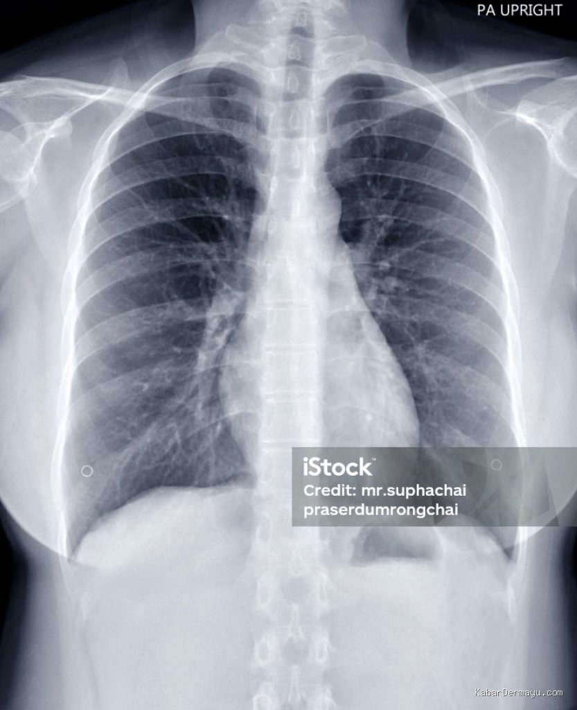 Penyebab Utama Gagal Medical Check Up MCU Pabrik Bagian Rontgen Paru-paru