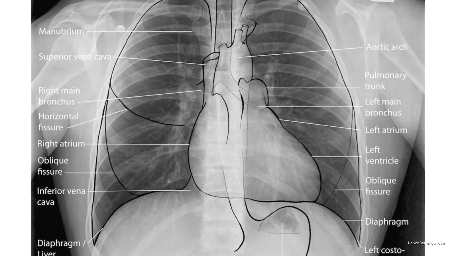 Penyebab Utama Gagal Medical Check Up MCU Pabrik Bagian Rontgen Paru-paru