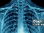 Photo by istockphoto.com - Penyebab Bekas Patah Tulang Masa Lalu Terdeteksi Dokter Saat Uji Fleksibilitas