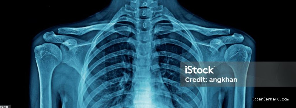 Photo by istockphoto.com - Penyebab Bekas Patah Tulang Masa Lalu Terdeteksi Dokter Saat Uji Fleksibilitas