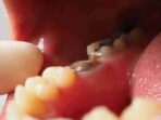 Photo by thesmileorthodontic.com - Penyebab Gigi Berlubang dan Karang Gigi Bikin Skor Kesehatan Kerja Berkurang
