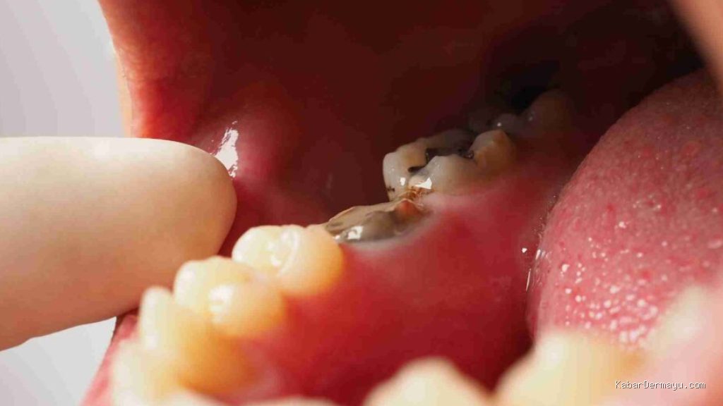 Photo by thesmileorthodontic.com - Penyebab Gigi Berlubang dan Karang Gigi Bikin Skor Kesehatan Kerja Berkurang