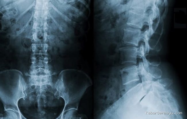 Photo by alomedika.com - Penyebab Skoliosis Tulang Belakang Miring Gagal Lolos Tahap Rontgen Tubuh