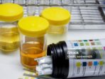 penyebab-urine-keruh-kuning-gelap-pasca-begadang-malam-sebelum-tes-kesehatan-29670 Photo by istockphoto.com - Penyebab Urine Keruh Kuning Gelap Pasca Begadang Malam Sebelum Tes Kesehatan